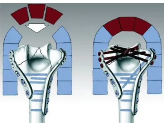 Figure showing the Interdigitating screws restoring keystone integrity of the arch 