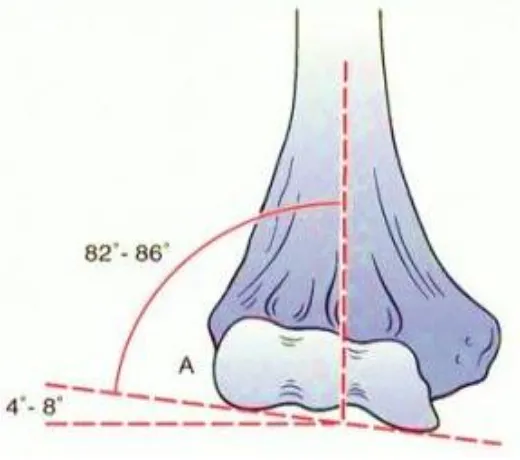 Figure showing Valgus angulation of the articular surface of the 