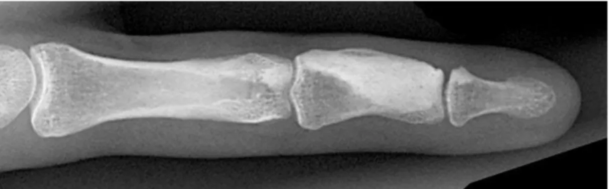 Figure 3.2: X-ray showing the three bones that make up the finger. [61] 