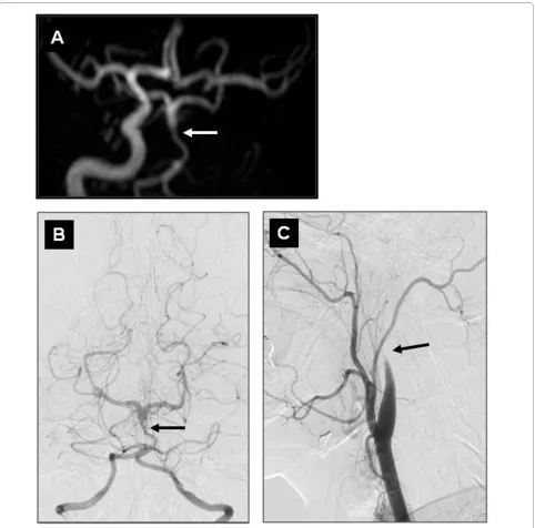 Figure 2 3D-TOF MRA and left-VA DSAaspect of both VA and proximal BA (filling defect on the mid basilar segment proximal to the SCA origin, corresponding to thrombus extension from the PTA (carotid artery DSA showing flamed-shaped occlusion of the left ICA