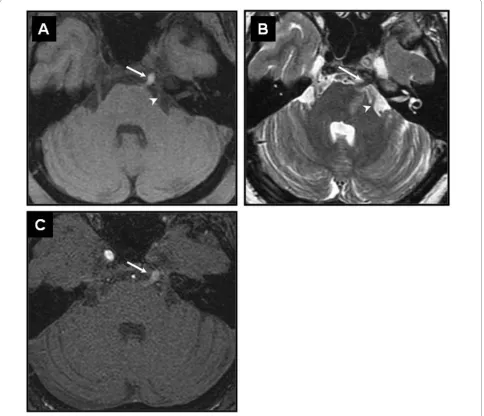 Figure 3 Thin axial sections MRI. Axial T1WI with fat-saturation (A), T2WI (B) and axial view of 3D-TOF MRA (C) showing the thrombus in the persis-tent PTA (arrow) appearing hyperintense in T1WI, hypointense on T2WI, medial to the cisternal portion of the trigeminal nerve (arrowhead).