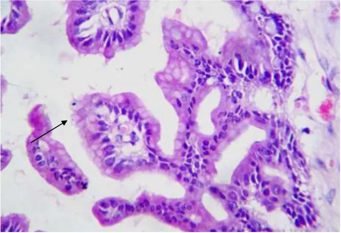 FIGURE 10A : MUCINOUS BORDERLINE TUMOR- SHOWING PAPILLARY FRONDS LINED BY MUCIN CONTAINING COLUMNAR EPITHELIUM WITH GOBLET CELLS- INTESTINAL TYPE (H&E- 10X) 