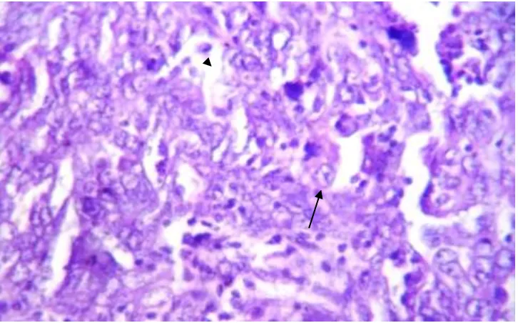 FIGURE 9A:  HIGH GRADE SEROUS CARCINOMA WITH  SOLID PROLIFERATION OF TUMOR CELLS AND   FOCAL  GLANDULAR ARCHITECTURE (ARROW) (H&E- 10X) 