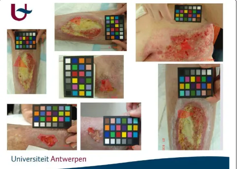 Figure 3 Chronic Wound Images with Reference Chart and a Region of Interest.