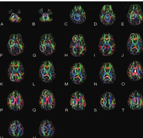 Fig 1. Region-of-interest placement for DTI analysis. Shown are corresponding regions of interest for the right hemisphere