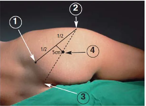 Figure 8: Site of sciatic nerve block by Labat approach 