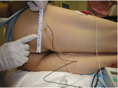 Figure 9:Mid gluteal approach 