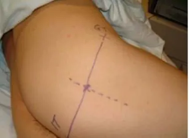 Figure 10: Gluteal approach 