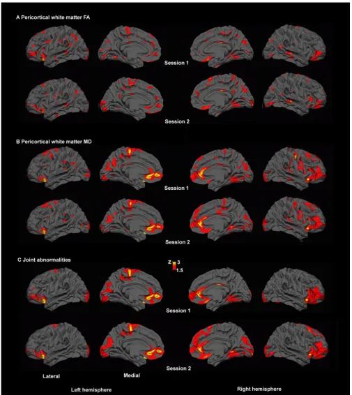 Figure 8Pericortical white matter abnormalitiesPericortical white matter abnormalities