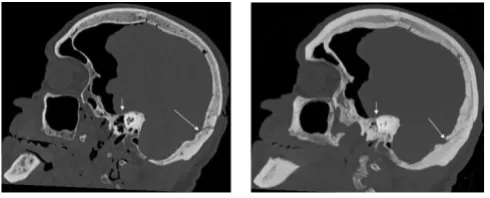 Figure 4occipital bone and petrous part of the temporal boneMPR (right) and MIP (left) sagittal images of fractures in the MPR (right) and MIP (left) sagittal images of frac-tures in the occipital bone and petrous part of the temporal bone