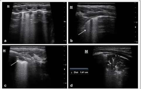 Fig. 1 Lung ultrasound images in a patient with bronchiolitis complicated by pneumonia.lung field showed a small subpleural consolidation without sonographic air bronchograms (arrow) - a typical finding in infants with bronchiolitisassociated with focally 