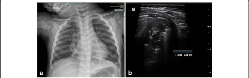 Fig. 2 Comparison of CXR and LUS in a patient with bronchiolitis complicated by pneumonia in the right lung