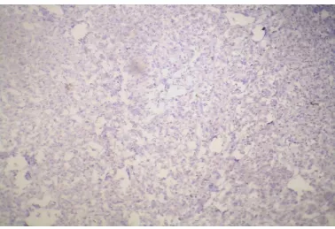 FIGURE:   7 INFILTRATING DUCTAL CARCINOMA NST SHOWING ER NEGATIVITY-10X 