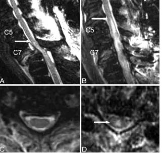 Fig 1. Short-interval follow-up cervical MR imaging of a67-year-old male ASIA A patient with SCI