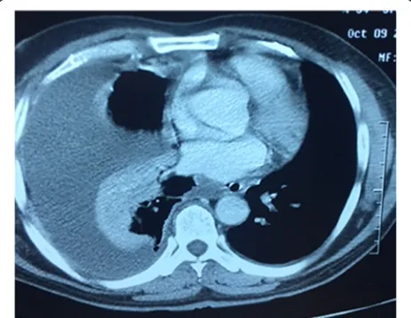 Fig. 1 CT scan of the chest showing loculated empyema