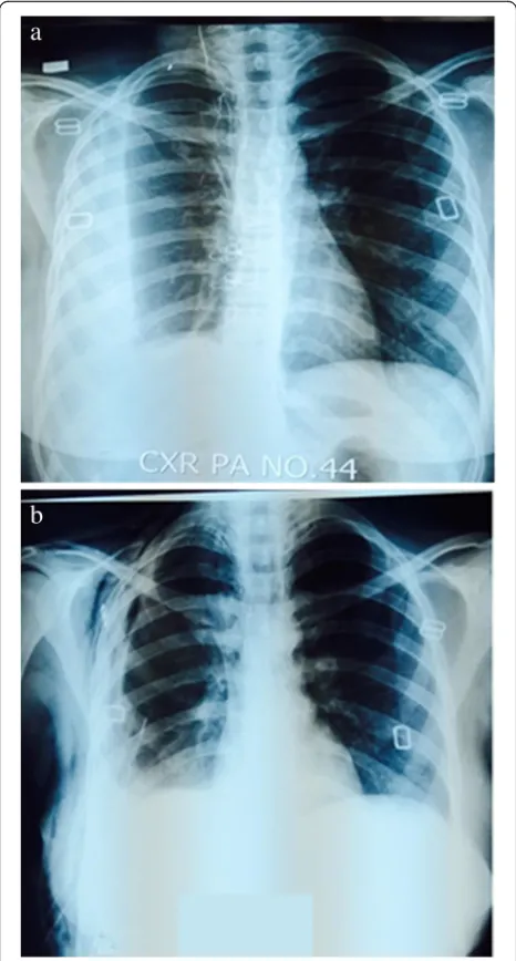 Fig. 5 Comparison of chest X-rays before and after medical Thoracoscopy(a) chest x-ray before thoracoscopy showing loculated pleural effusion (b)chest x-ray after thoracoscopy showing complete resolution ofmultiloculated and organized empyema