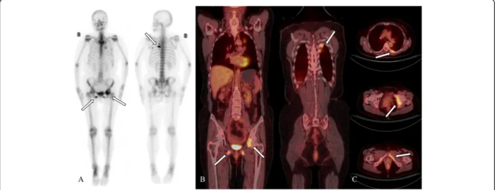 Figure 3 A 54-year-old woman with left lung cancer. Bone scanning (BS) shows focally increased uptake in the left ninth, tenth, and twelfthposterior ribs, three to five lumbar vertebrae and nearby regions of the lesser trochanter of the right femur (A)
