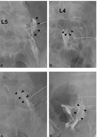 Fig 1. Insufficient infiltration and insufficient passage. A,Insufficient infiltration of the root, compressed by the herni-ated L4–5 disk