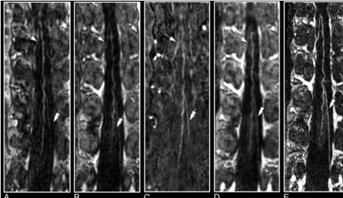 Fig 11. Comparison of contrast-enhanced MR angiography of spinal cord vessels with use of gadopentetate dimeglumine (Magnevist; A, B, and C) and the blood pool agent MS-325(Vasovist; C, D and E) in the same patient with a thoracoabdominal aortic aneurysm