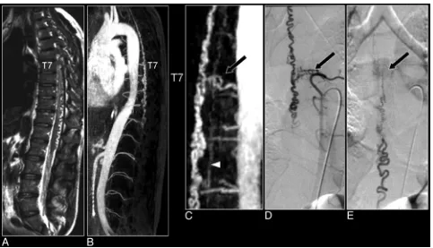 Fig 6. Multiplanar reformation of a 3D MR angiography image set of the spinal cord demonstrating the visualization of the AKA (extended part of the ASA