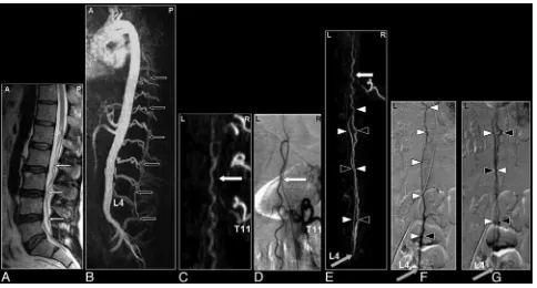 Fig 9. SAVM of the filum terminale in a 61-year-old male patient visualized by MR and catheter angiography: the problem of differentiation between this rare type of SAVM and spinal(suspicion of a vascular spinal cord abnormality ((angiography images in ear