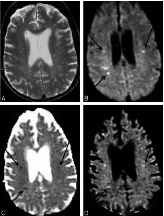 Fig 2. DWI enables more sensitive and specific diagnosis ofation coefficient image, also known as the exponential dif-fusion image, shows these lesions as remaining hyperintense(acute cerebral ischemia in a case of embolic infarcts due toendocarditis