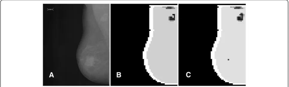 Figure 4 A small mass lesion showing up in the segmented image for most values of θ. Panel A