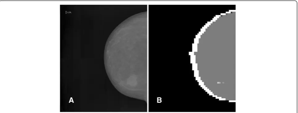 Figure 6 Large-sized massive opacity segmentation.The image segmented with Segmentation of a large-sized massive opacity