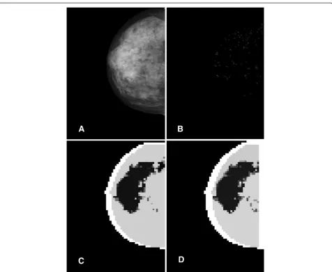 Table 3 Overlap of the cluster with the ROI for micro-calcifications images