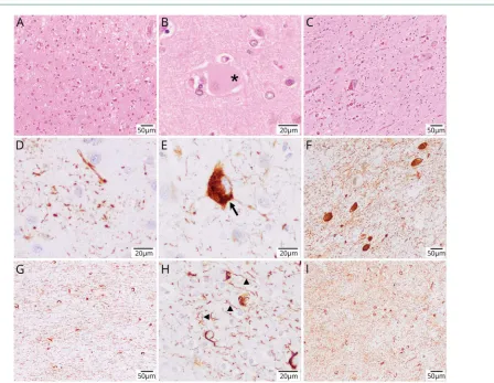 Figure 2 These images showcase the pertinent neuropathologic findings of case 2