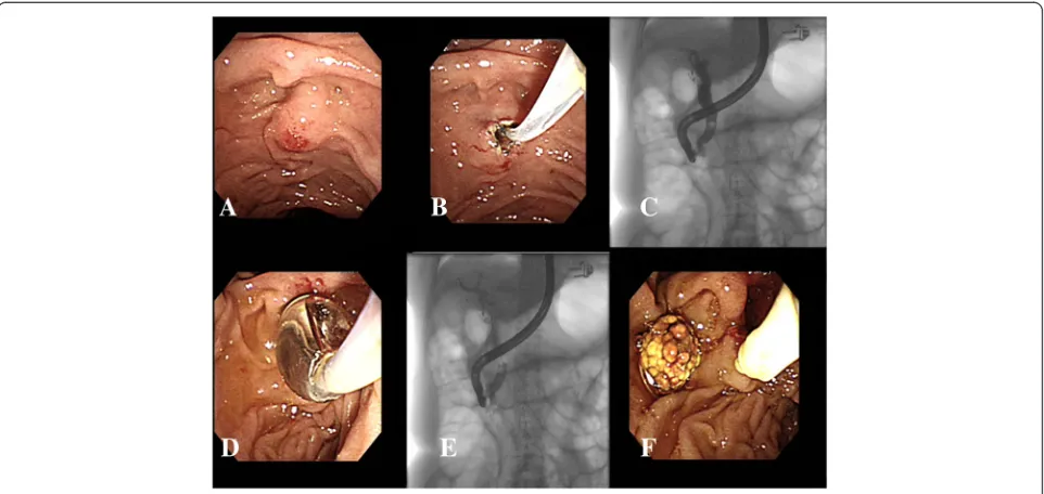 Fig. 1 acannulation; (with the extent of cutting was less than half the length of the papillary mound; ( Difficult biliary cannulation was due to failure of 10 attempts at duodenal papilla; (b) Limited precut sphincterotomy was performedc) Common bile duct stone was found after successful biliaryd) Endoscopic papillary balloon dilation was performed after limited precut sphincterotomy; (e and f) Common bile duct stonewas extracted by retrieval balloon