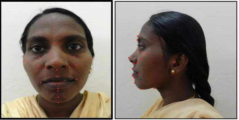 Fig.5: SCANNED PATIENT FACE WITH LANDMARKS 