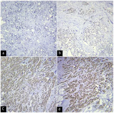 Fig. 1. Immunohistochemical staining of Nanog showing different expression levels in breast cancer samples (magnification  100(a)severe staining for Nanog (score 3)