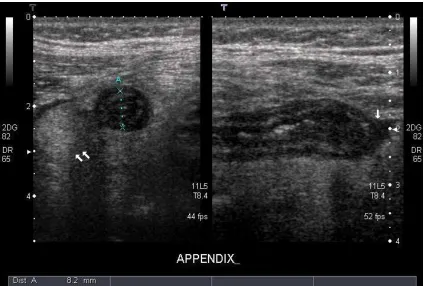 Fig. 9 USG showing appendicular lumen in appendicitis 