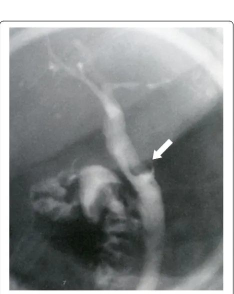 Fig. 1 Endoscopic retrograde cholangiopancreatography showshaemobilia from the orifice of ampulla of Vater