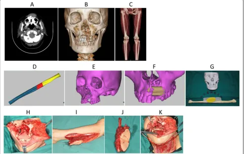 Fig. 3 a CT transect showed that the lesion infiltrated into the left vestibule area, involving the nasal septum and the nasal floor; b Three-dimensional reconstruction of maxillofacial region, bone defect; c and lower extremity vessels by CAD technique after CT angiography; dComputer simulation for repair of maxillofacial region; e The position, length, arc of the fibula and the angle of the osteotomy of the fibula usedby computer simulation and repair; f The effect of computer simulation after repair; g Three-dimensional printers’ rapid prototyping model; h Theleft maxillary tumor resection (resection including the left maxillary sinus wall, inferior wall, anterior wall, the section on the right side of themaxillary sinus and inferior wall, by simultaneous resection of nasal septum and nasal tumor infiltrating the bottom); i The skin flap was designedas the center of the skin before operation, and the skin of the left calf was cut into the perforator to dissect the perforating branch of theperoneal artery; j Vascularized free fibula myocutaneous flap was made by truncated fibula; k Repair effect of vascularized free fibulamyocutaneous flap during operation