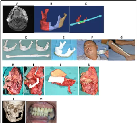 Fig. 4 Preoperative performance and computer simulation of patients, model of rapid prototyping by 3D printer, one-stage repair of mandibularCustomize the osteotomy plate according to the model after the rapid prototyping, determine the interception range 