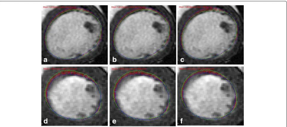 Fig. 12 Comparison of APD using SSD_SGD_QN, GMM and CPD with202 control points for registration of the MICCAI 2009s cardicsegmentation challenge dataset