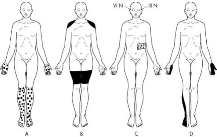 Figure 8. showing various presentations of diabetic neuropathy 
