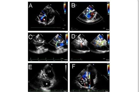 Fig. 1 Echocardiogram before, during and after 3 months of operation findings: a, b Pre-operation echocardiography demonstrated a giant rightcoronary artery aneurysm (65*48 mm) (white star) with a fistula to the RA (blue arrow); c, d Intraoperative TEE sho