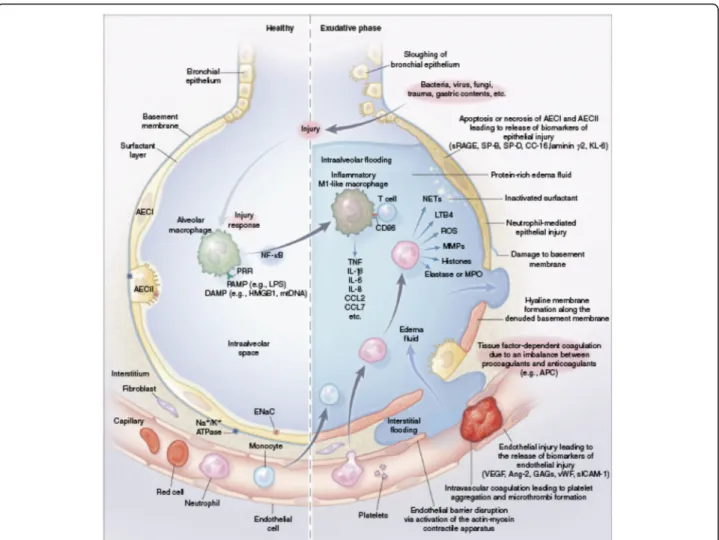 Fig. 1 Pathobiology of the exudative phase of ARDS. The healthy alveolar-capillary unit (left) and the exudative phase of ARDS (right)