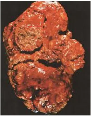 Fig - Macroscopic appearance showing diffuse parenchymal necrosis 