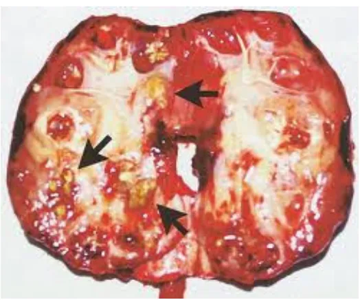 Fig -  Cut   cross section shows diffuse parenchymal necrosis and 