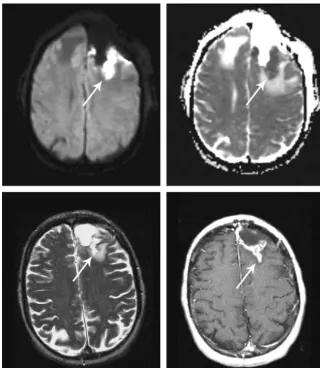 Fig 2. Infarcts on immediate postoperative MR images arecommon. These infarcts often demonstrate nodular gadolin-ium enhancement on subsequent studies, a finding that couldbe easily confused with tumor