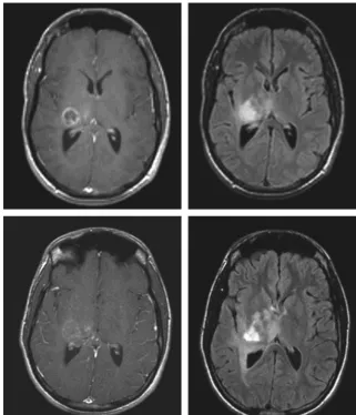 Fig 3. Novel therapeutic agents in clinical trials may requireuse of imaging techniques other than gadolinium-enhancingtumor