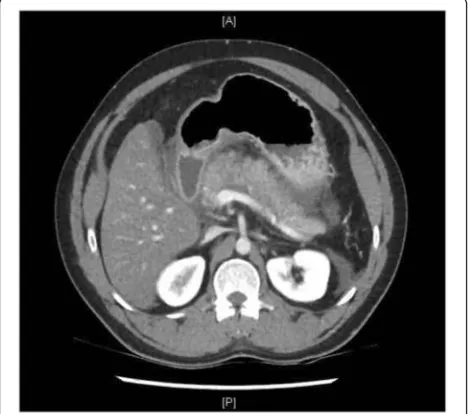 Fig. 1 Timeline summarising important clinical events. ACS: Abdominal compartment syndrome; CT: computed tomography; IAP: intraabdominal pressure