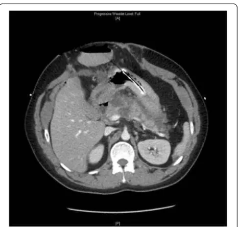 Fig. 4 Computed tomography of the abdomen a month aftersurgical decompression revealed a large retroperitoneal collectionseen within lesser sac between pancreatic tail and stomach, consistentwith walled-off necrosis