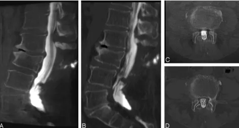 Fig 3. MPR images from a 75-year-old woman with persistent back pain after multisegmental laminectomy