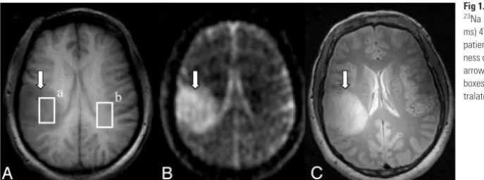 Fig 1. Transverse T1-weighted (arrow identifies the low-grade glioma in each image. Whiteboxes outline tissue regions in tumor (tralateral side (A; TI/TR/TE � 500/9.5/5 ms),23Na (B; TR/TE � 25/3.8 ms), and FSE (C; TR/TE � 4500/15ms) 4T MR images of a typic