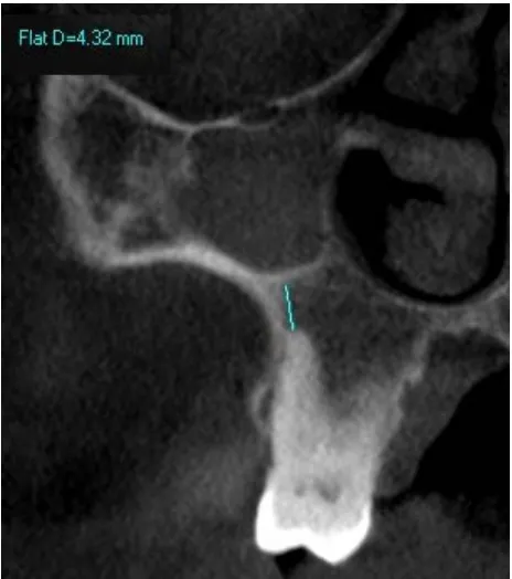 Figure 5. Class 1 relationship between the palatal root and the sinus floor (1.27 mm)